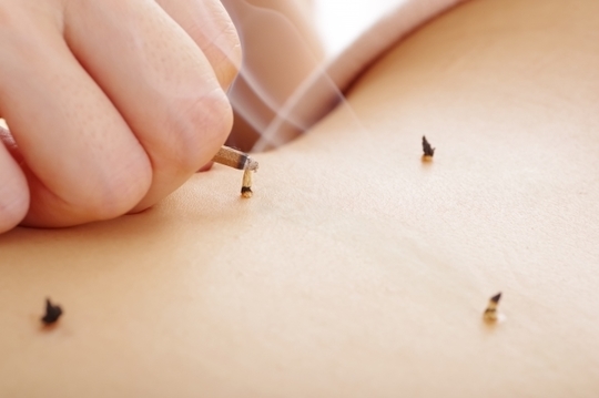 お腹の不調を優しく整え、身体の芯から回復を促す温かなお灸の風景